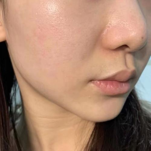 激光祛痘几天后能化妆？-图3