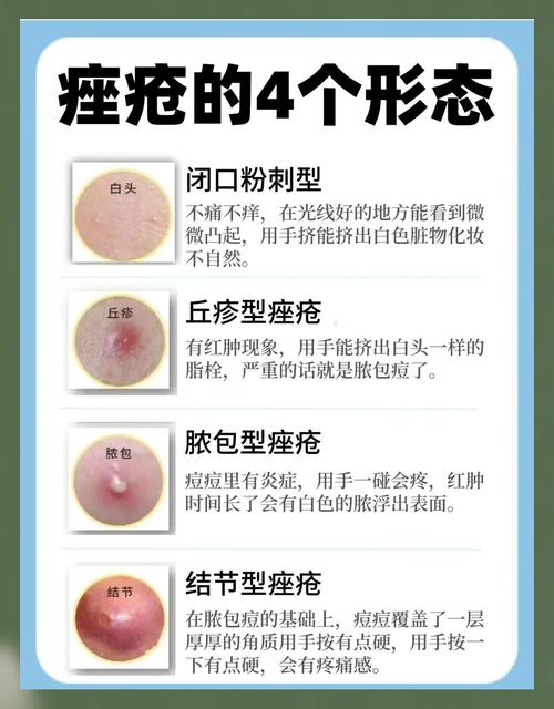 祛痘后如何护理不留痘印？-图3