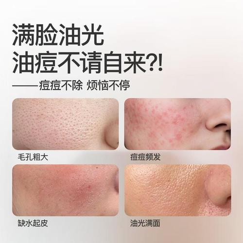 祛痘印面膜什么牌子最有效？-图1