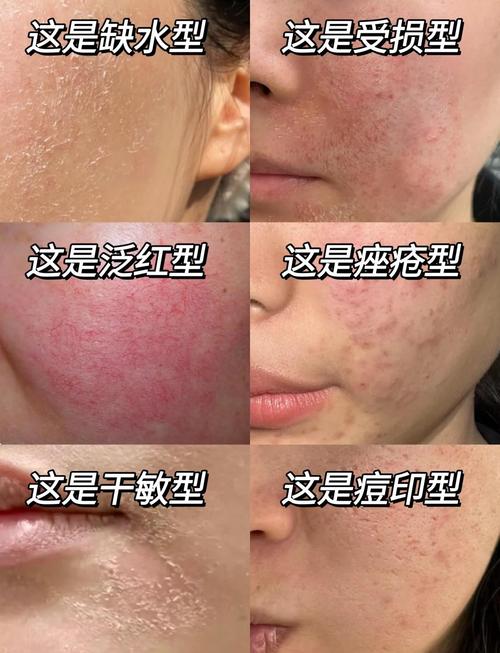 CPB护肤过敏了？原因是什么？-图1