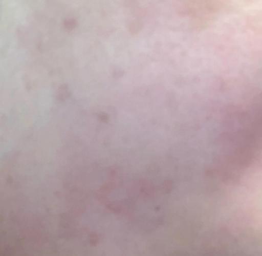 CPB护肤过敏了？原因是什么？-图3