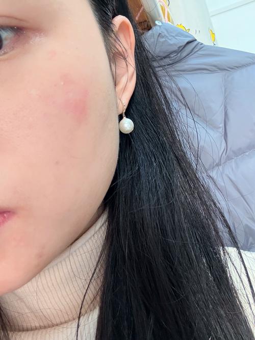 CPB护肤过敏了？原因是什么？-图2