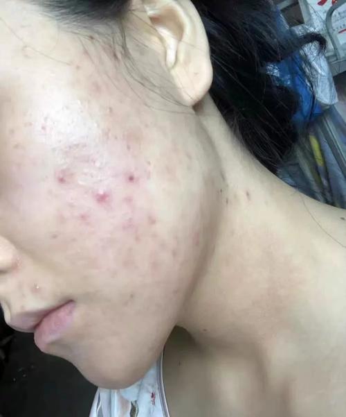 祛痘印痘坑，用什么最有效？-图1