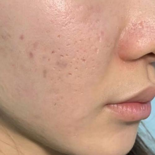 祛痘印痘坑，用什么最有效？-图3