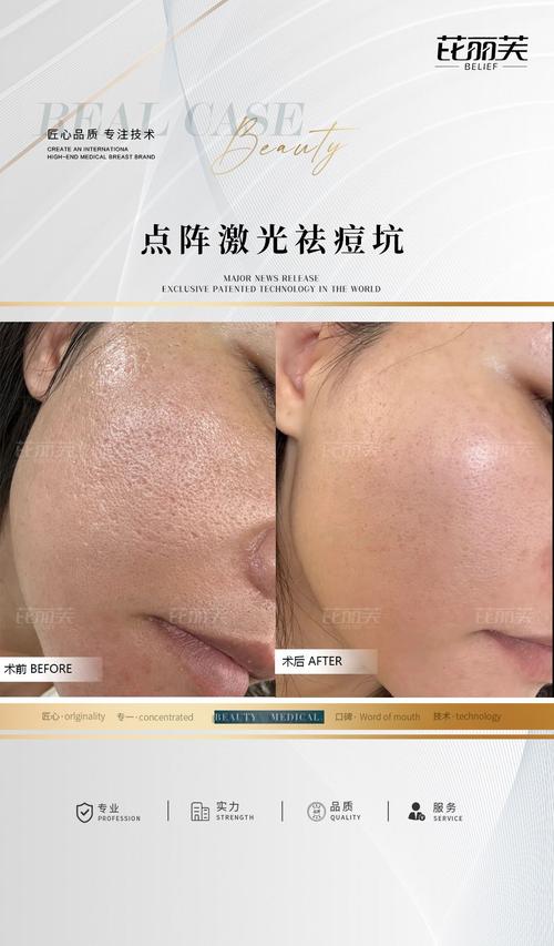 激光祛痘印会留痘坑吗？-图2