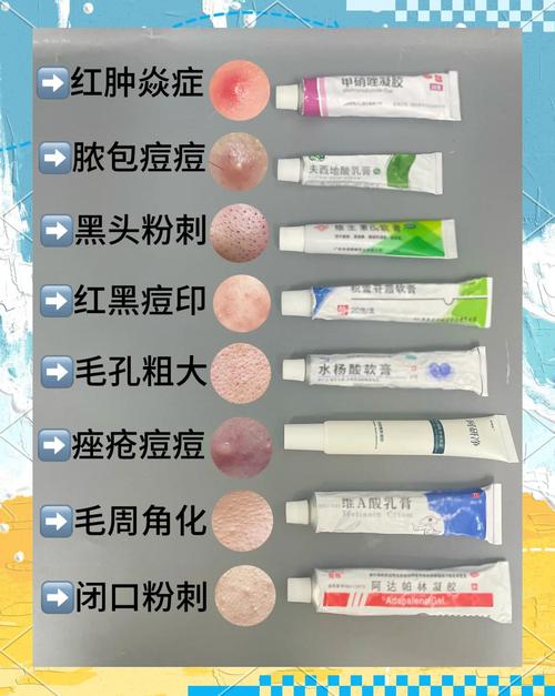 祛痘祛印,什么方法最有效?-图1 祛痘祛印,什么方法最有效?-图1