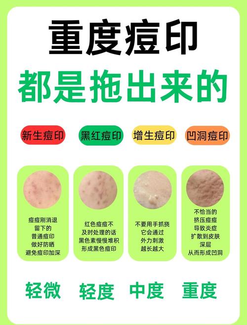 怎么祛痘和痘印小窍门-图1 怎么祛痘和痘印小窍门-图1