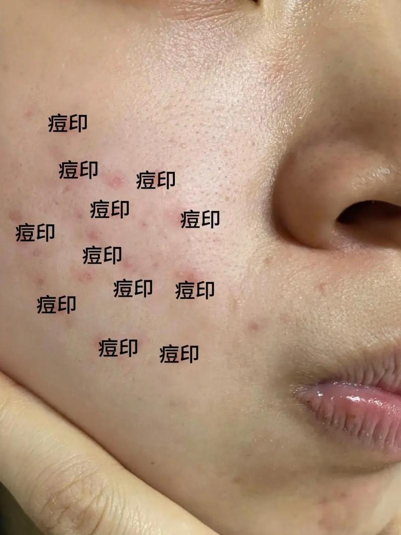 怎么祛痘和痘印小窍门-图2 怎么祛痘和痘印小窍门-图2