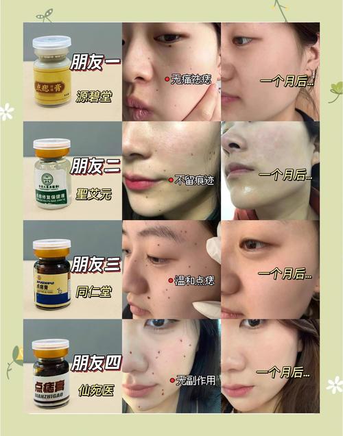 祛痣后多久能正常用护肤品？-图3