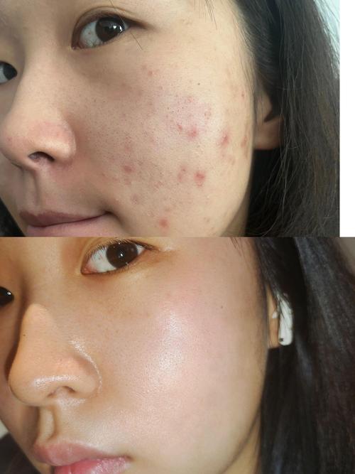 祛痘产品真有效？还是智商税？-图1