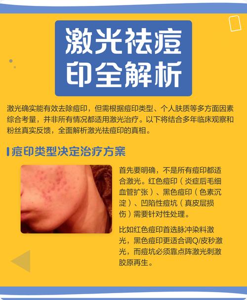 激光祛痘印痘坑要多久见效？-图1