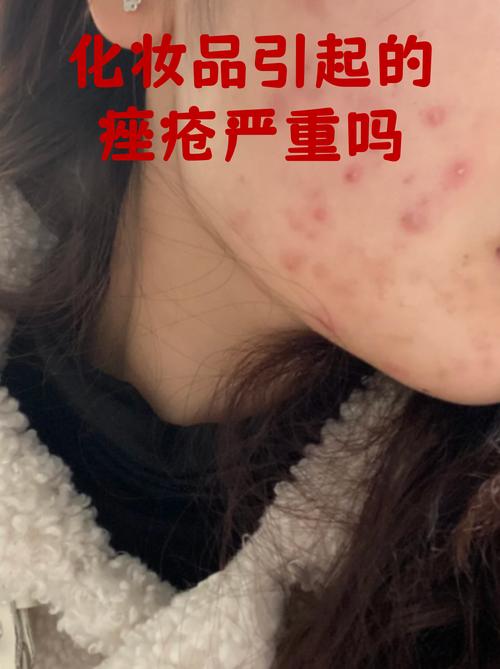 祛痘前必须先挤痘吗？-图2