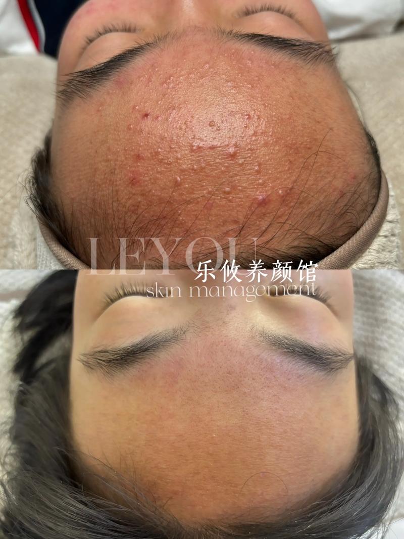 祛痘前必须先挤痘吗？-图3