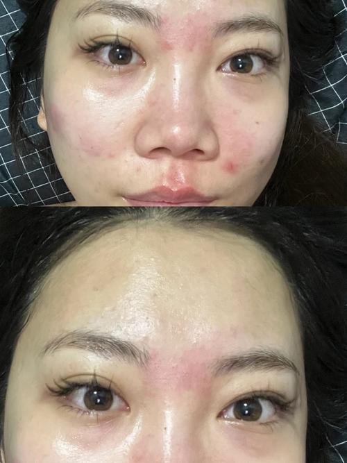 cosme大赏祛痘印产品真的靠谱吗？-图2