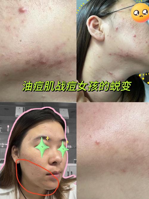 Agnes祛痘真的有效吗？-图2