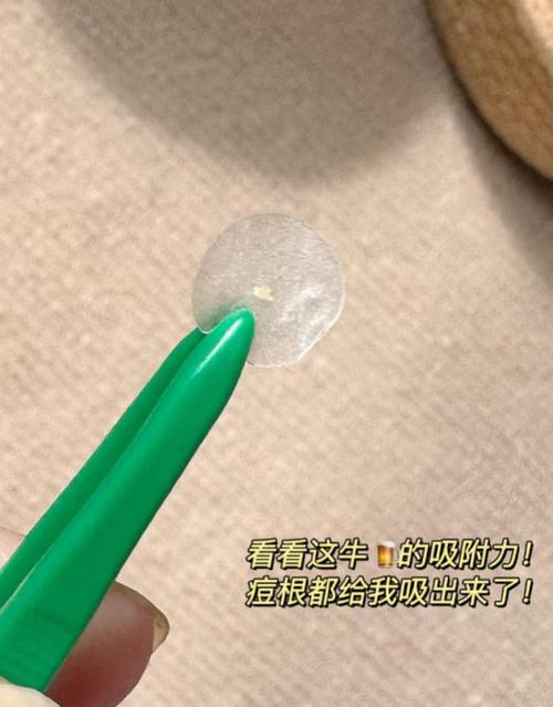 曼秀雷敦祛痘贴如何祛痘?原理是什么?-图3 曼秀雷敦祛痘贴如何祛痘?原理是什么?-图3