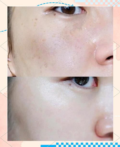 中药祛痘祛斑美白配方真的有效吗？-图1