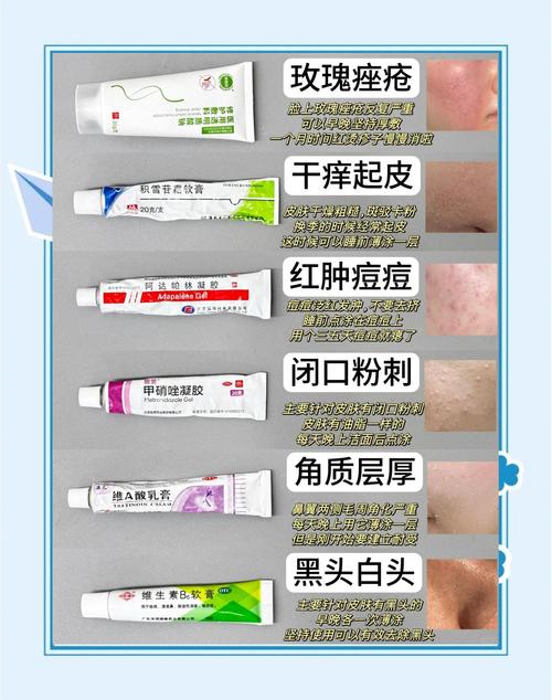 不长痘用祛痘产品有必要吗？-图2