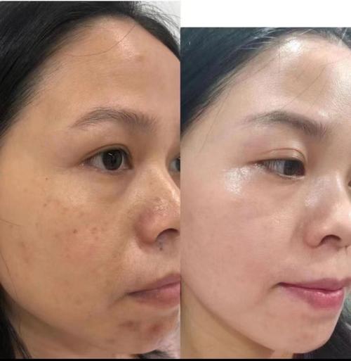 祛斑和祛痘，哪个效果更好？-图1