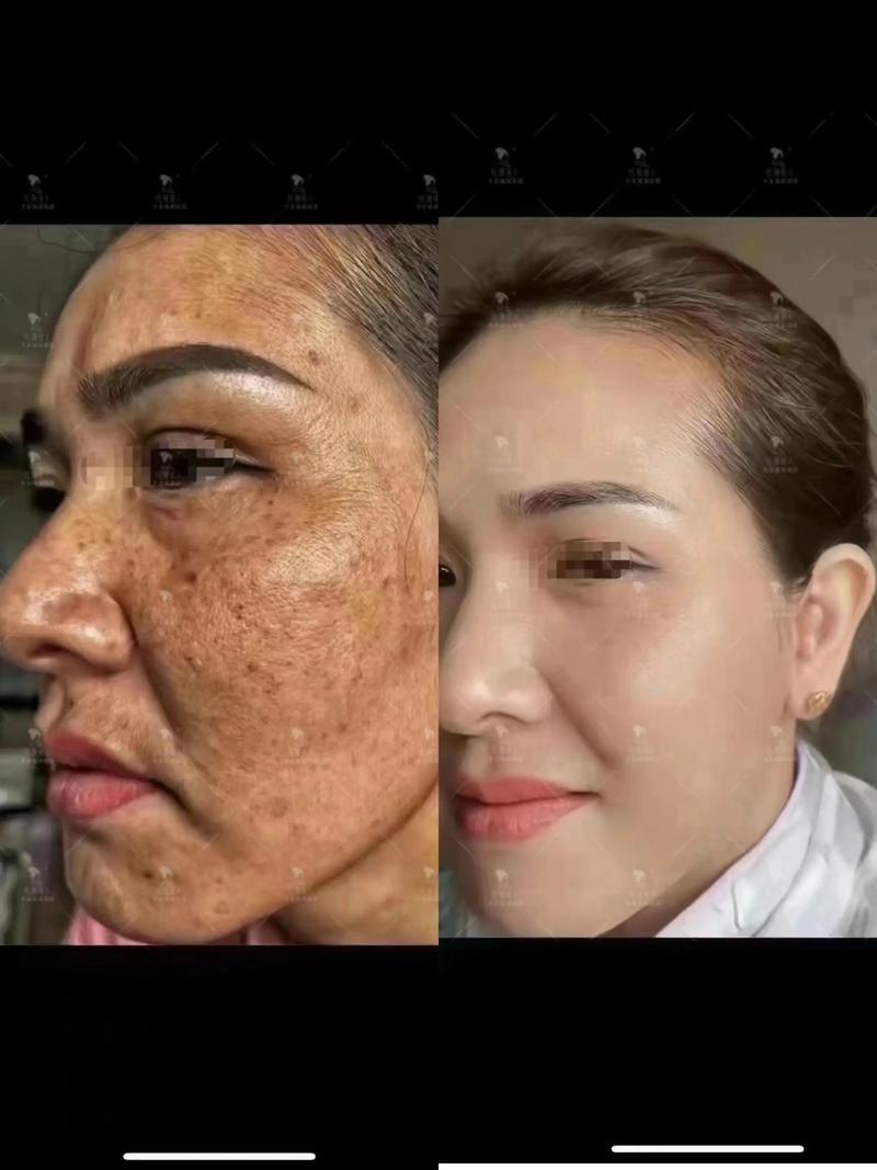 祛斑和祛痘，哪个效果更好？-图2