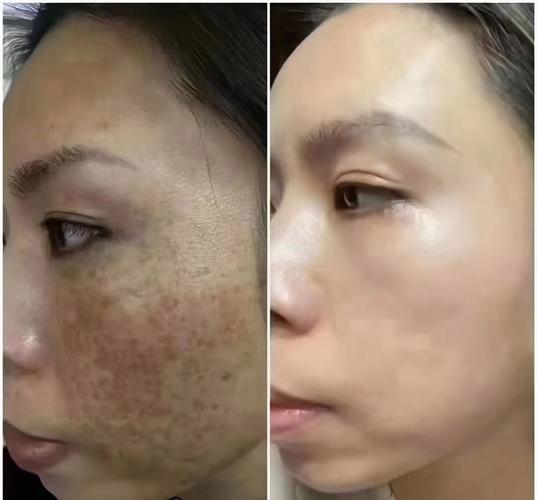 祛斑和祛痘，哪个效果更好？-图3