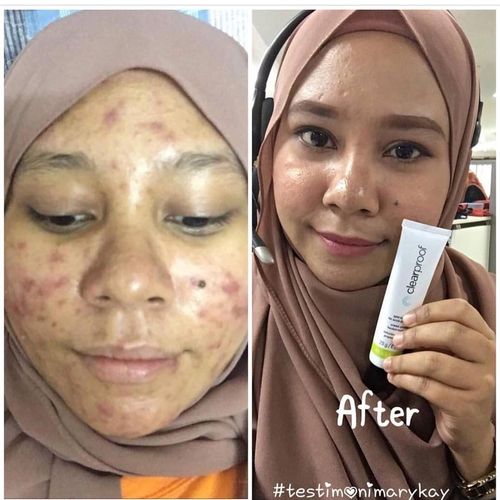 Mary Kay祛痘效果真的好吗？-图3