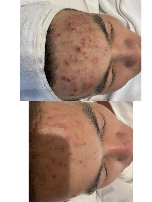 Mary Kay祛痘效果真的好吗？-图2