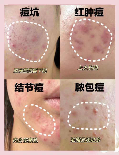 Clinique祛痘效果到底怎么样？-图2