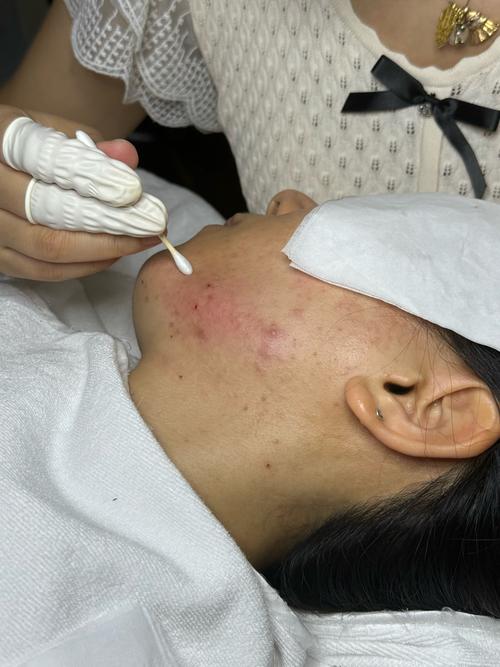 lissage祛痘效果真的好吗？-图3