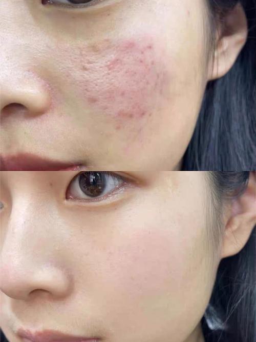 lissage祛痘效果真的好吗？-图2