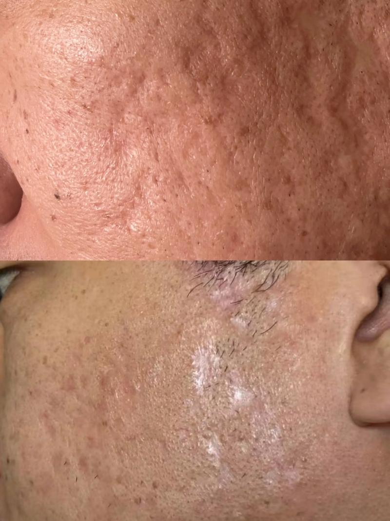 痘印、痘疤、痘坑,如何有效祛除?-图2 痘印、痘疤、痘坑,如何有效祛除?-图2