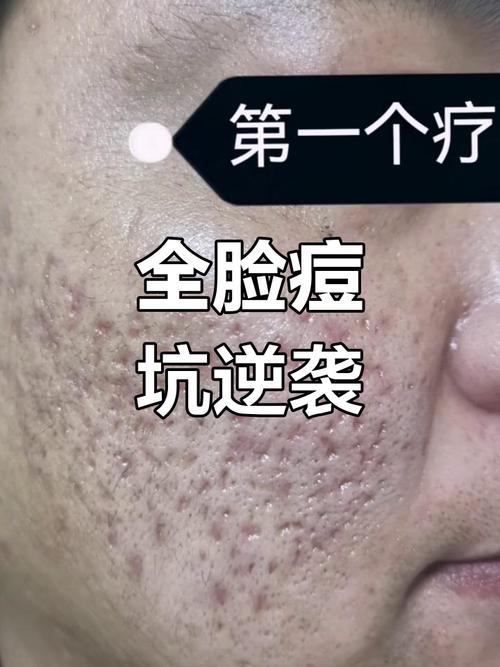 痘印、痘疤、痘坑,如何有效祛除?-图3 痘印、痘疤、痘坑,如何有效祛除?-图3