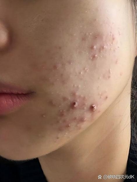 臻元祛痘精华素效果真的好吗？-图3