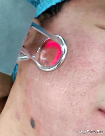 激光祛痘多久见效？-图1