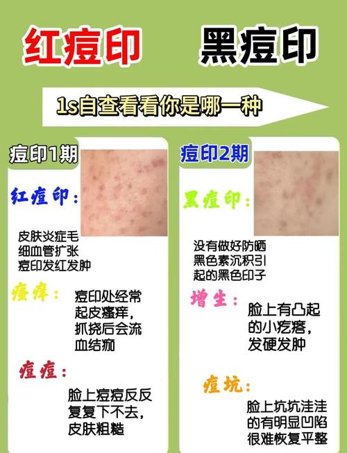 祛痘后红印怎么快速消除？-图1
