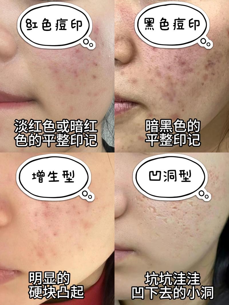 祛痘后红印怎么快速消除？-图2