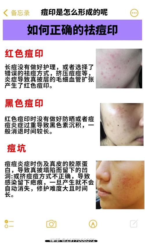 祛痘后红印怎么快速消除？-图3