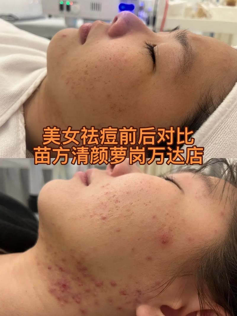 瓷肌祛痘印效果真的好吗？-图2