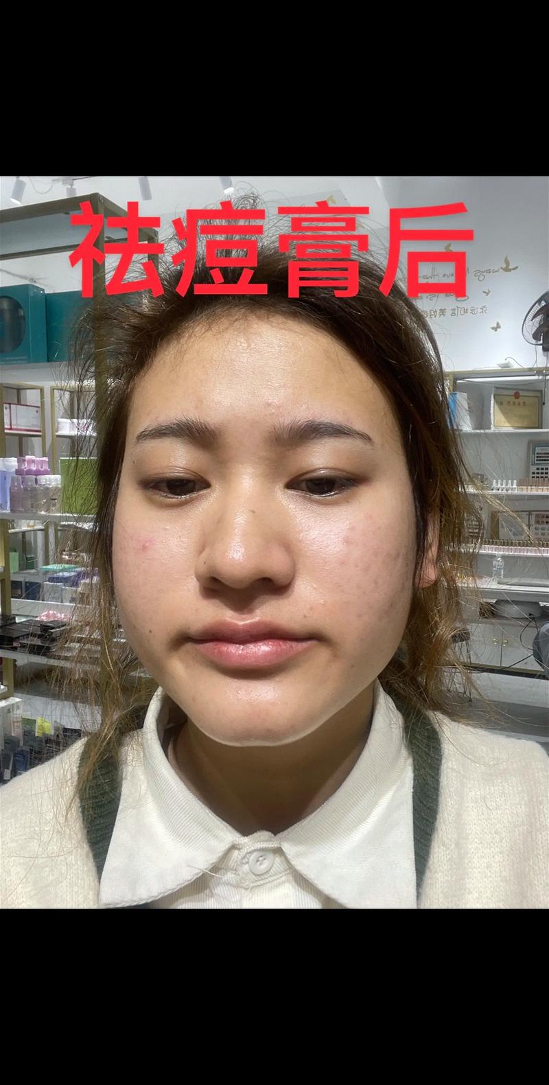 瓷肌祛痘印效果真的好吗？-图3