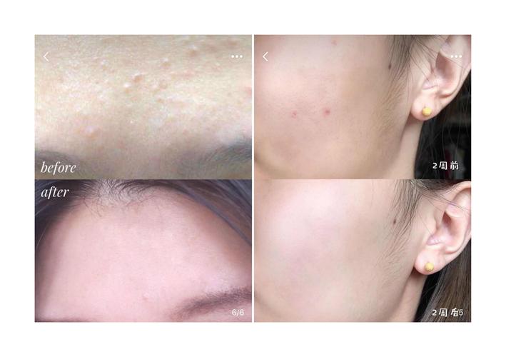 达尔肤祛痘效果到底好不好？-图2