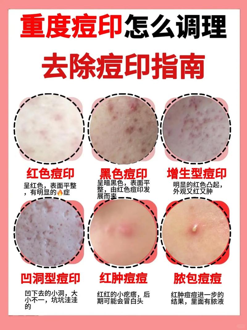 祛痘印哪种方法最有效？-图2