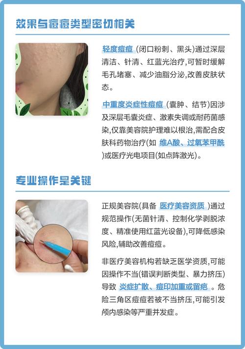 美容院祛痘真的有效吗？-图3