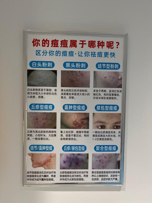 美容院祛痘真的有效吗？-图1