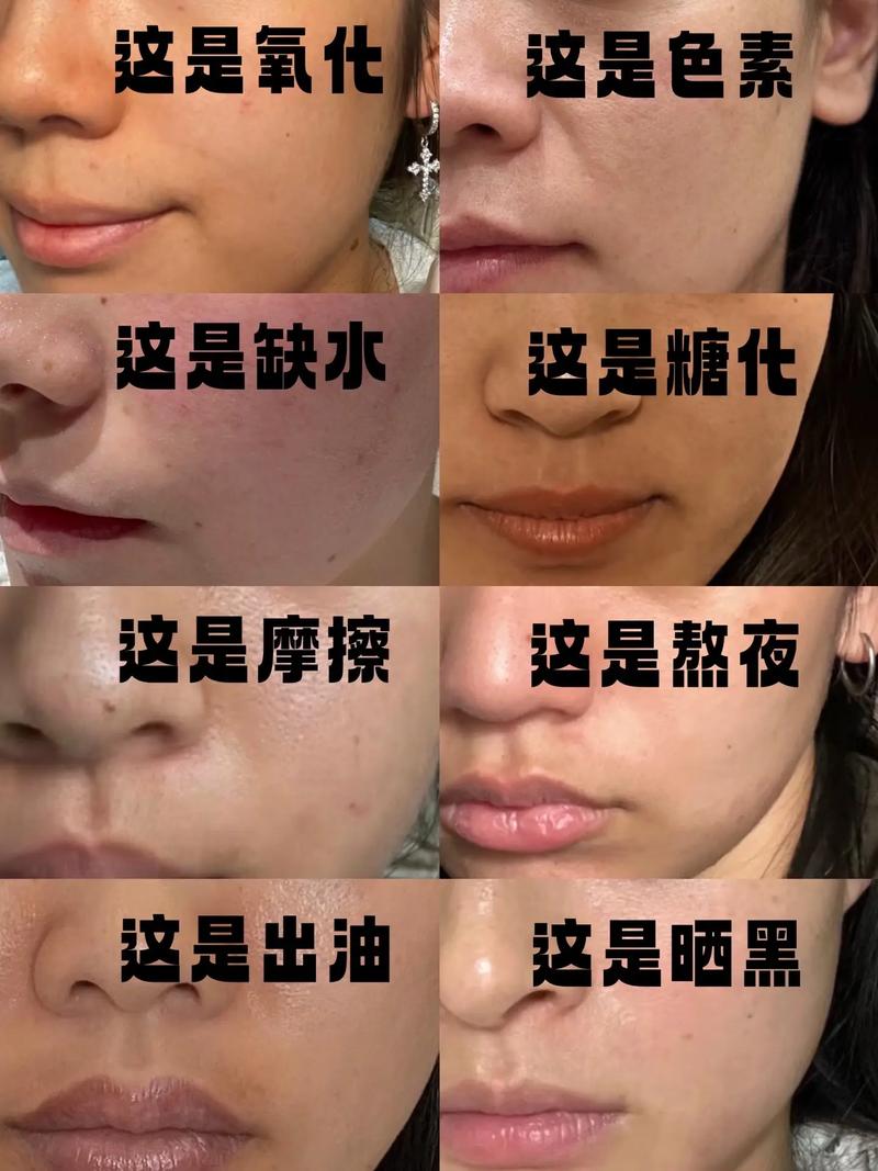 糖洗脸真能祛痘印吗？-图3