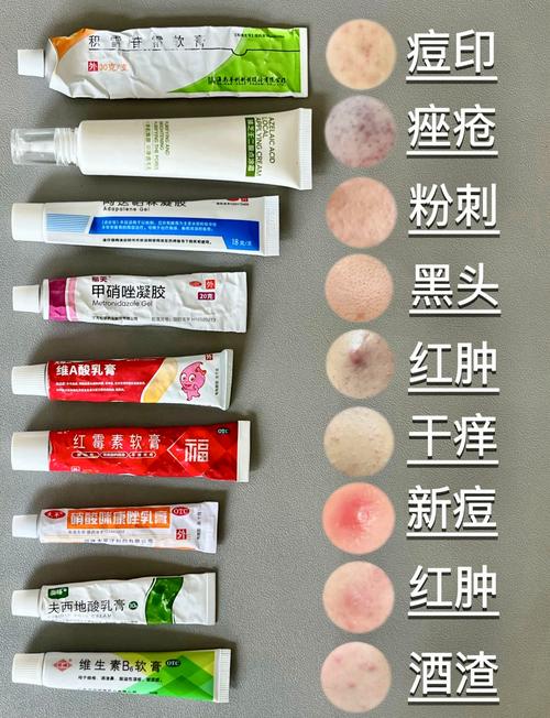 中药祛痘膏含激素吗？-图2