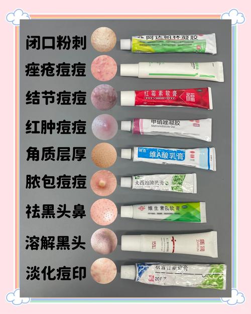 祛痘膏真的能治痘痘吗？-图3
