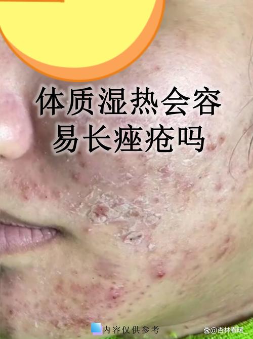 九红祛痘会依赖吗？-图3