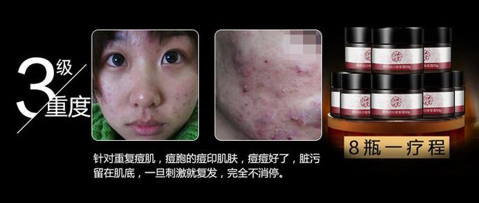 汉萱本草祛痘印效果真的好吗？-图2