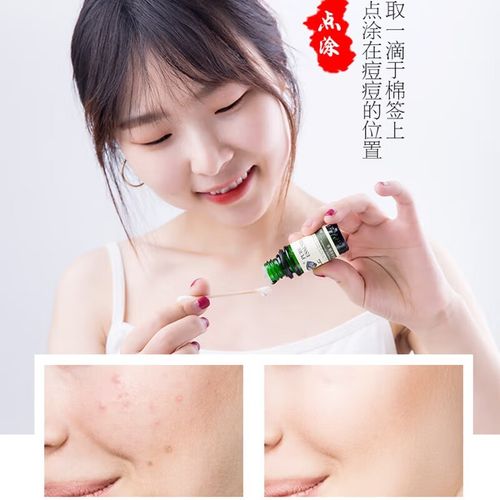 茶树精油能祛痘印吗？-图2