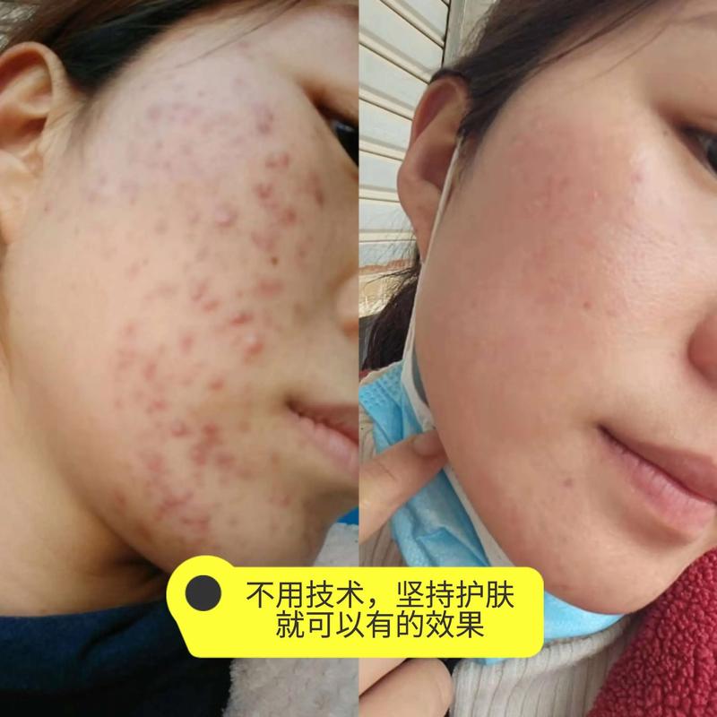 丽颜肌祛痘效果真有那么好吗？-图3